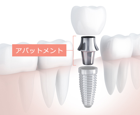 アバットメント（支台部）