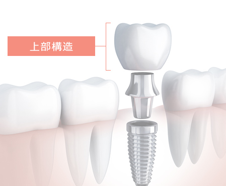 上部構造（人工歯冠）