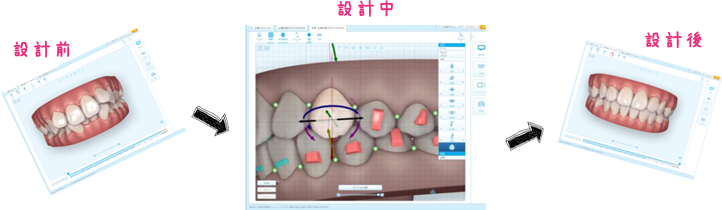 専用ソフトで治療完了までの歯並びを設計