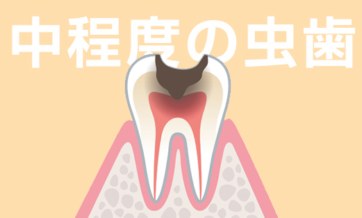 中程度の虫歯