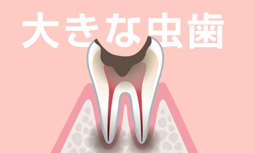 大きな虫歯や深い虫歯